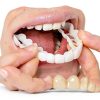 Temporary Smile Solutions YZINSIGHT Pair Natural Top Bottom Adjustable-0