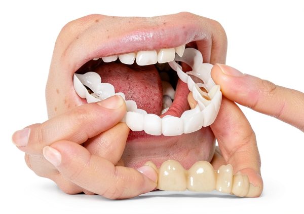 Temporary Smile Solutions YZINSIGHT Pair Natural Top Bottom Adjustable-0