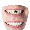 Smile Seek Removable Dentures - Natural Clip In Tooth (1 Tooth)-2