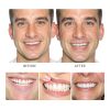 Adjustable Snap On Dentures Upper & Lower by EELHOE Prosthetic Kit-8