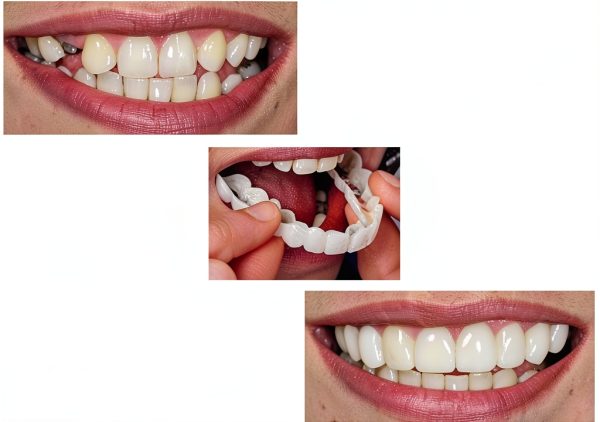 Cosmetic Snap On Teeth Veneers Enshi Kaiseo White Upper & Lower Cover-2