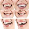 Temporary Smile Support Adjustable LEOONER 2 Pairs Provisional Crown-1